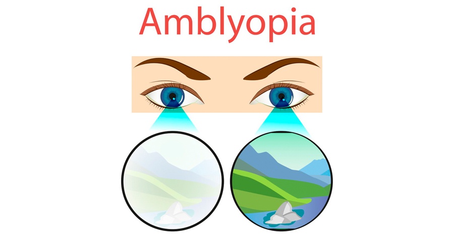 An Easy-to-Read Guide on Amblyopia